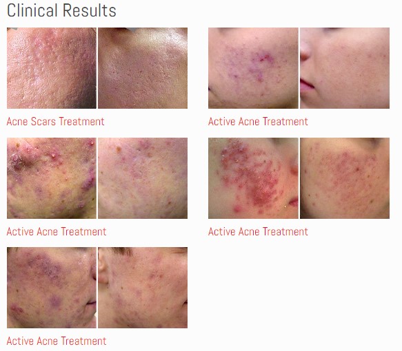 Acne Treatment1