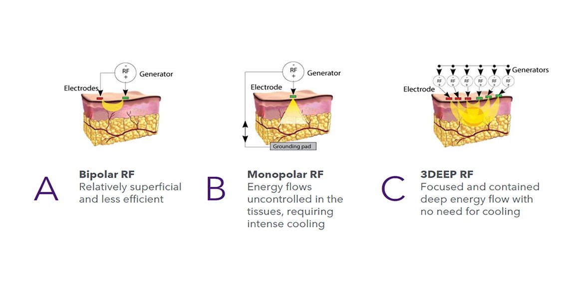 3DEEP-Phased-Controlled-RF-Technology (1)